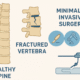 Spinal Fracture